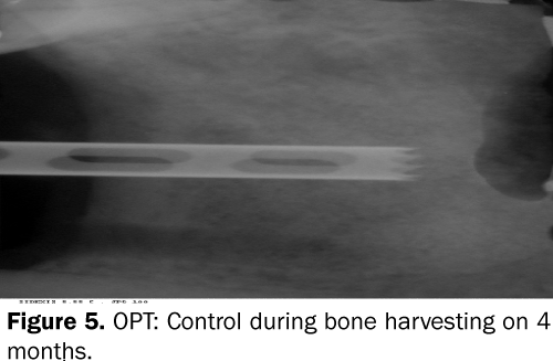 dental-sciences-bone-harvesting-months