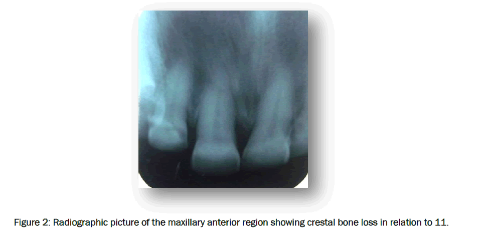 dental-sciences-bone-loss-relation