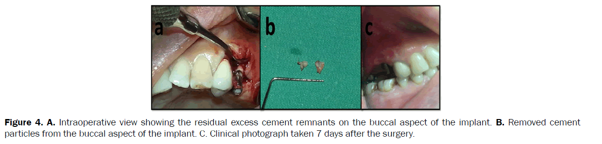 dental-sciences-buccal-aspect-implant