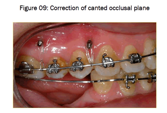 dental-sciences-canted-occlusal-plane