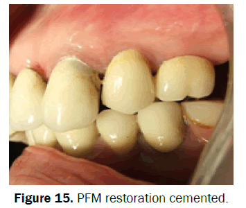 dental-sciences-cemented