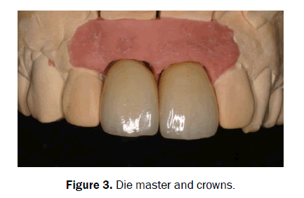 dental-sciences-crowns