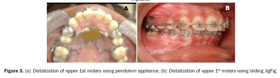 dental-sciences-crowns