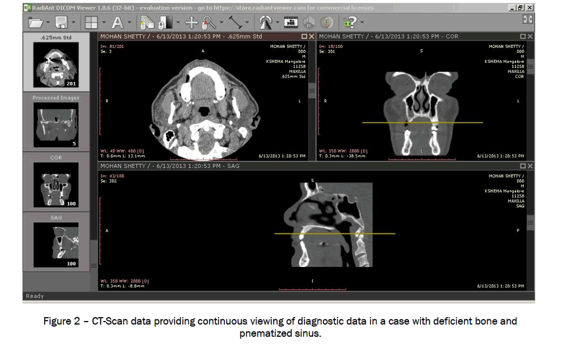 dental-sciences-deficient-bone-pnematized-sinus