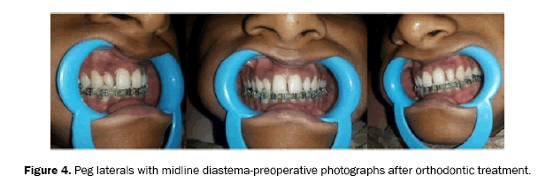 dental-sciences-diastema-preoperative