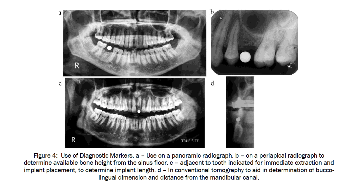 dental-sciences-distance-mandibular-canal