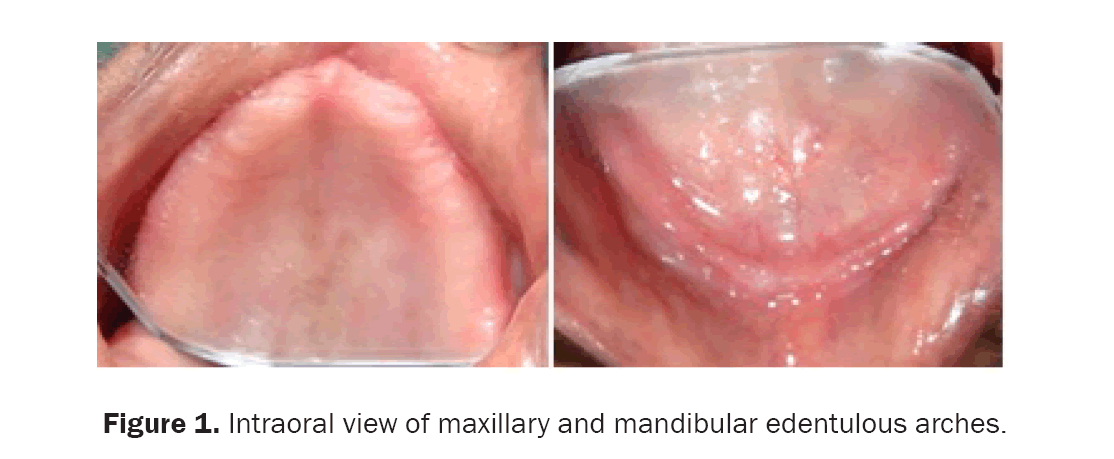 dental-sciences-edentulous