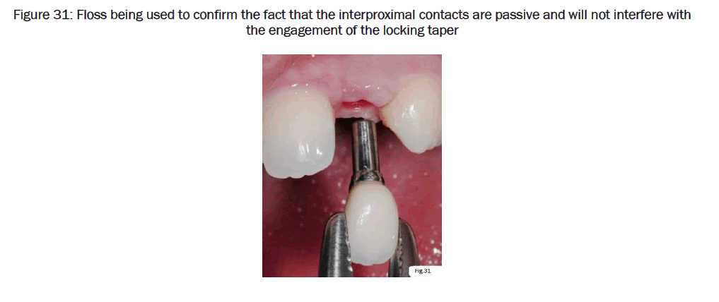 dental-sciences-engagement-locking-taper