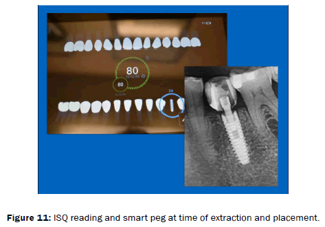 dental-sciences-extraction-placement