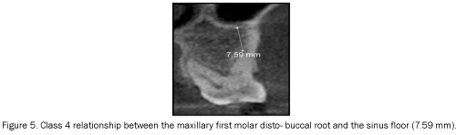 dental-sciences-first-molar-disto