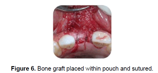 dental-sciences-graft-placed