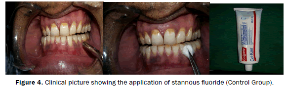 dental-sciences-groups-Clinical-picture-application-stannous