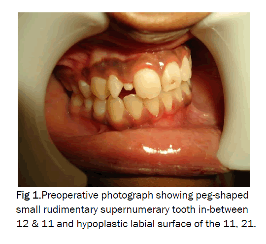 dental-sciences-hypoplastic-labial-surface
