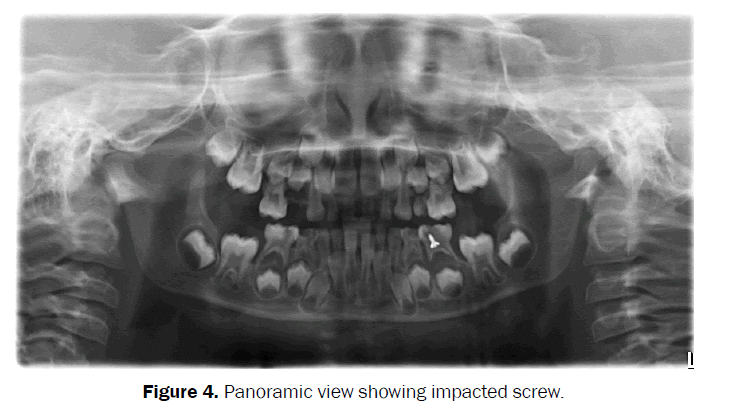 dental-sciences-impacted