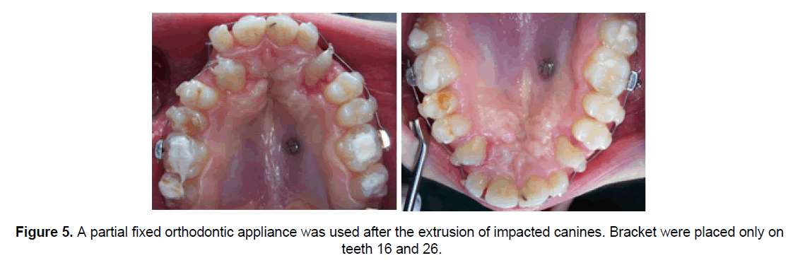 dental-sciences-impacted-canines