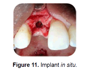 dental-sciences-implant-situ