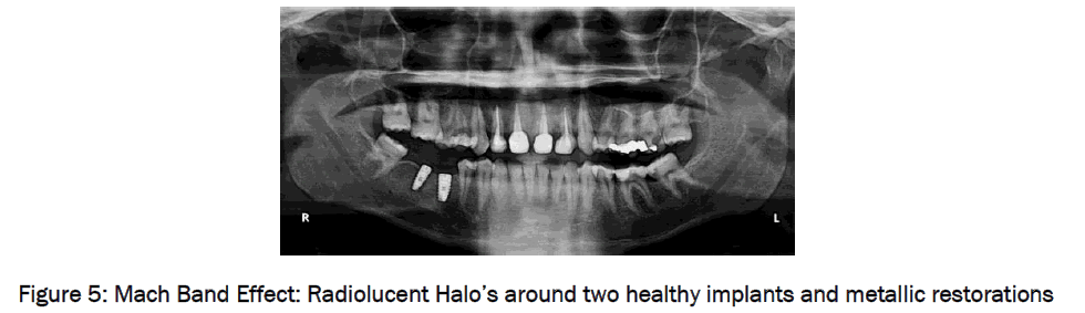 dental-sciences-implants-metallic-restorations