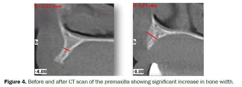 dental-sciences-increase-bone-width