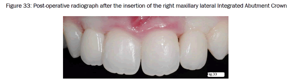 dental-sciences-lateral-Integrated-Abutment-Crown