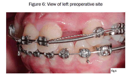 dental-sciences-left-preoperative-site