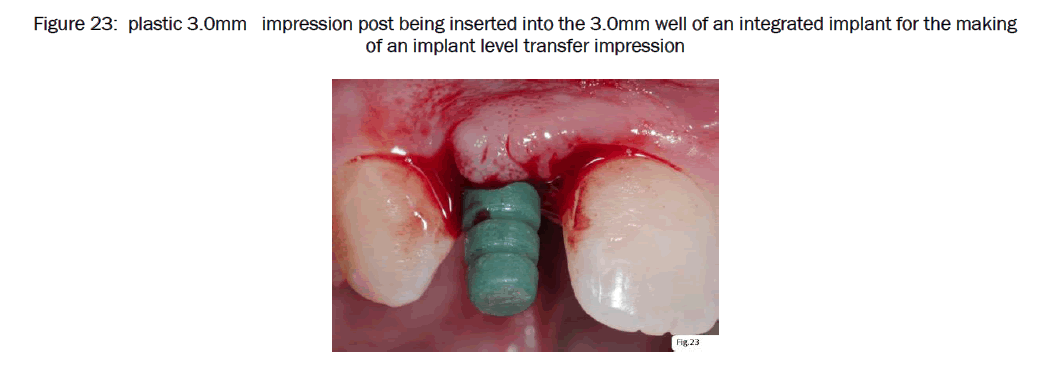 dental-sciences-level-transfer-impression