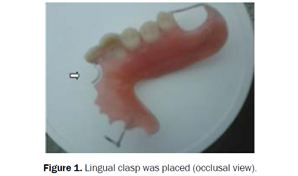 dental-sciences-lingual-clasp