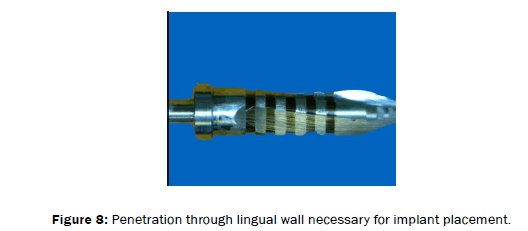 dental-sciences-lingual-wall