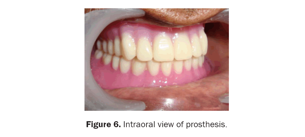 dental-sciences-liquid-prosthesis