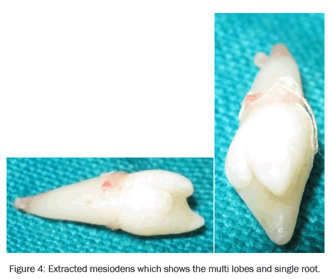 dental-sciences-lobes-single-root