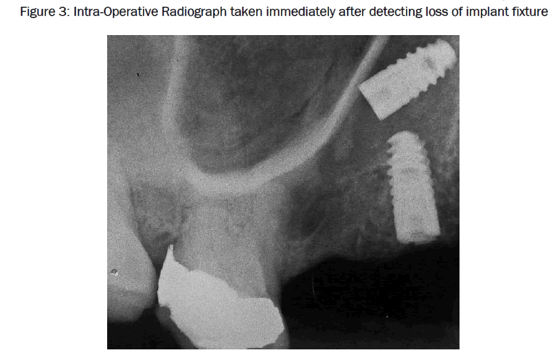 dental-sciences-loss-implant-fixture