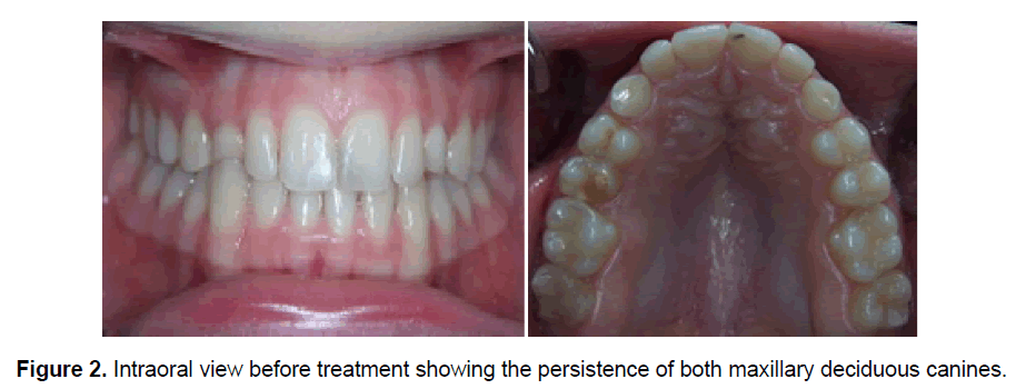 dental-sciences-maxillary-deciduous