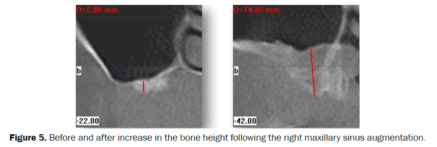 dental-sciences-maxillary-sinus-augmentation