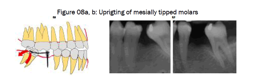 dental-sciences-mesially-tipped-molars