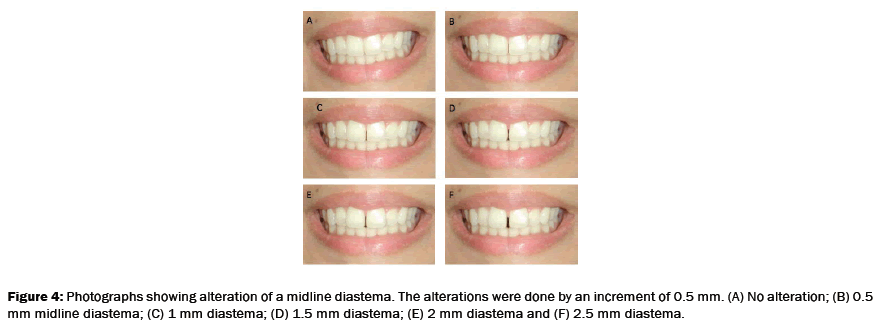 dental-sciences-midline-diastema