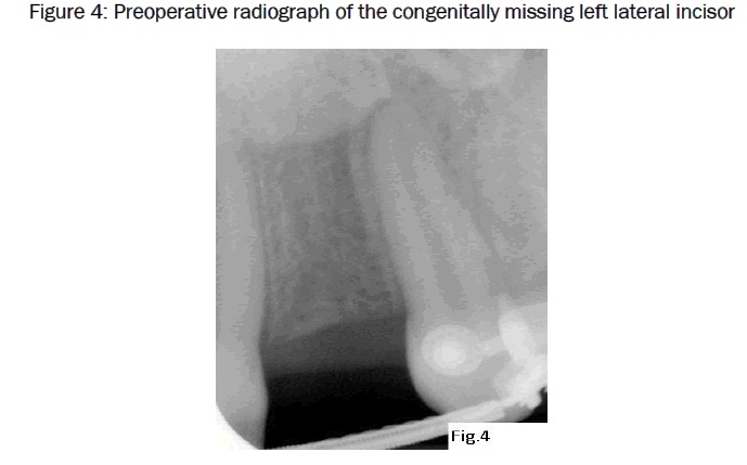 dental-sciences-missing-left-lateral-incisor