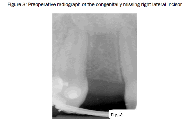 dental-sciences-missing-right-lateral-incisor