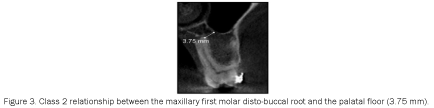 dental-sciences-molar-disto-buccal