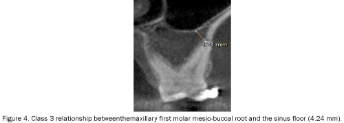 dental-sciences-molar-disto-buccal