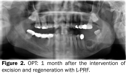 dental-sciences-month-intervention-excision