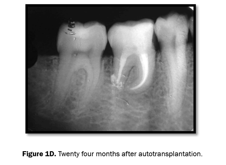 dental-sciences-months-after-autotransplantation