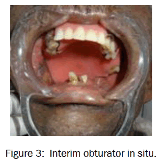 dental-sciences-obturator