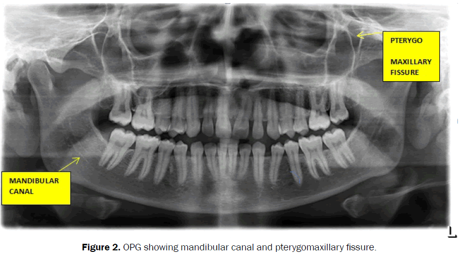 dental-sciences-opg-mandibular-canal