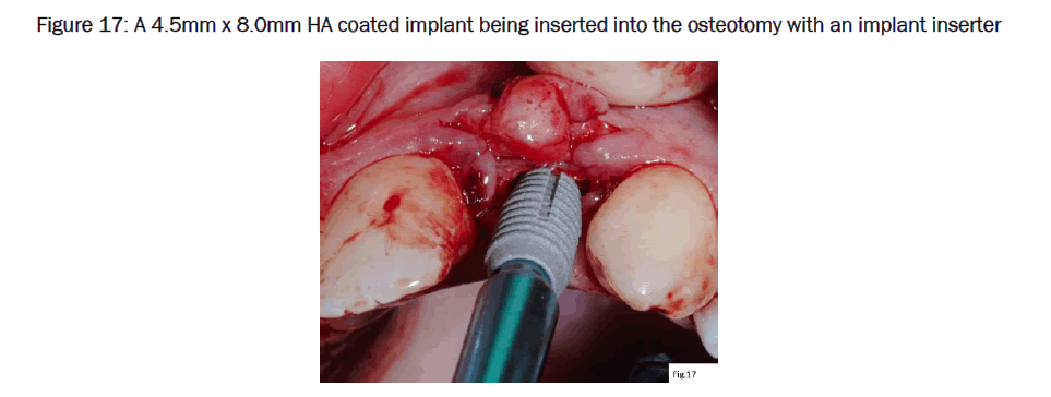 dental-sciences-osteotomy-implant-inserter