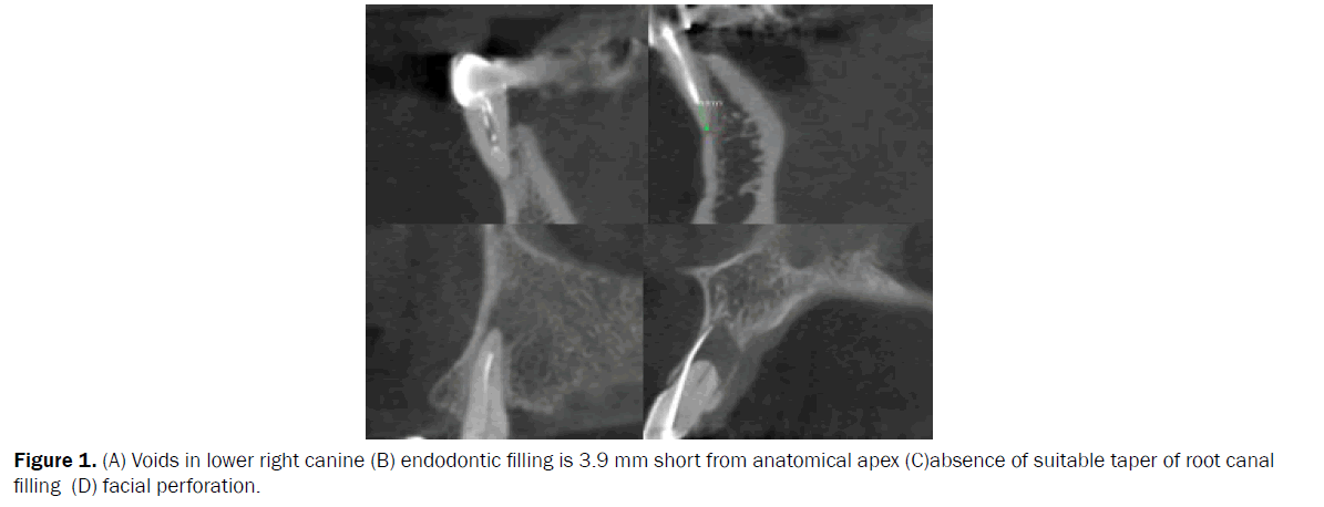 dental-sciences-perforation