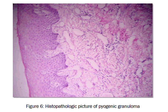 dental-sciences-picture-pyogenic-granuloma