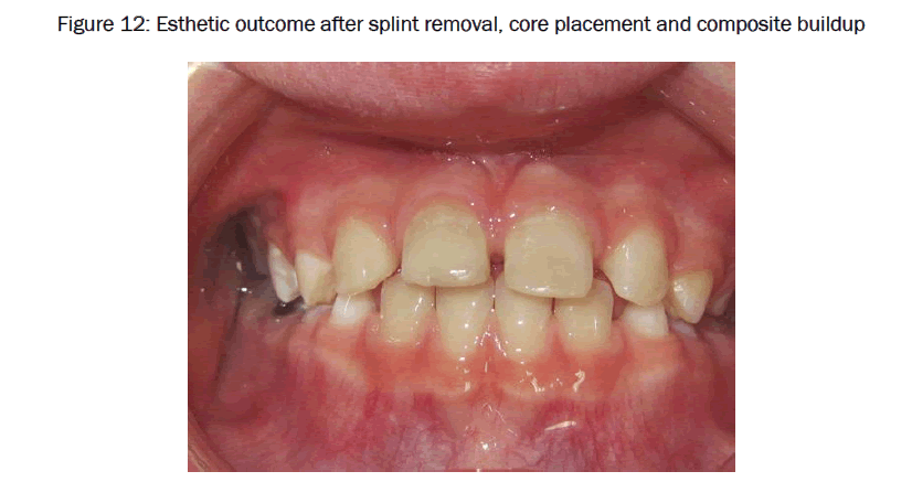 dental-sciences-placement-composite-buildup