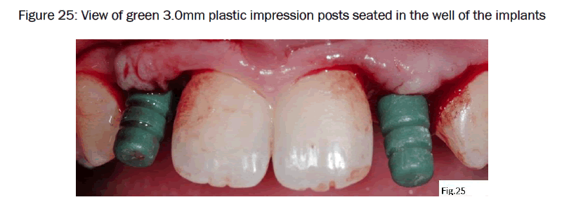 dental-sciences-plastic-impression-posts