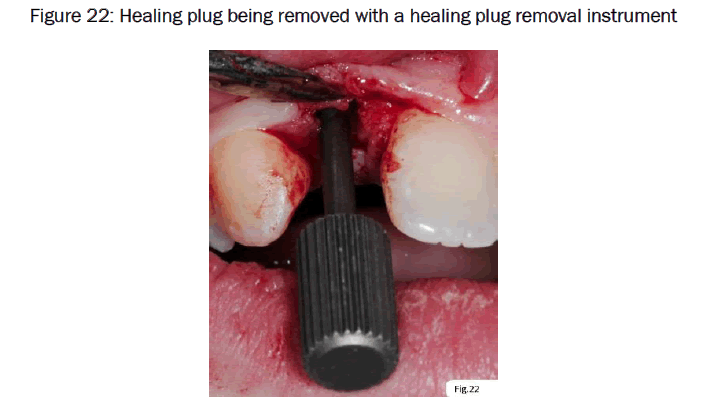 dental-sciences-plug-removal-instrument