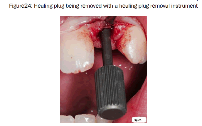 dental-sciences-plug-removal-instrument