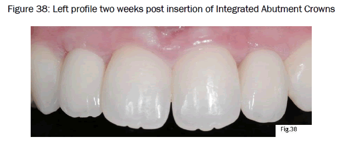 dental-sciences-post-insertion-Integrated